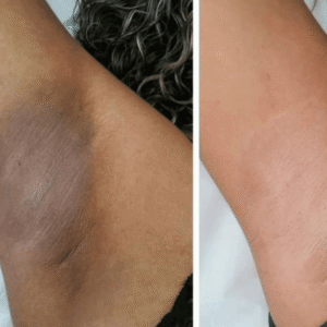 Vergonha de levantar os braços? Entenda por que as axilas escurecem