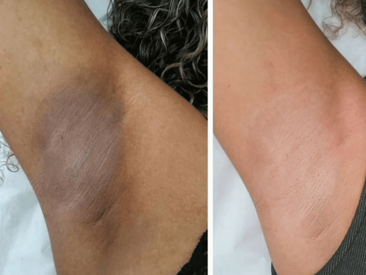 Vergonha de levantar os braços - Entenda por que as axilas escurecem - imagem de uma comparação de antes e depois, axila escura e uma clara.